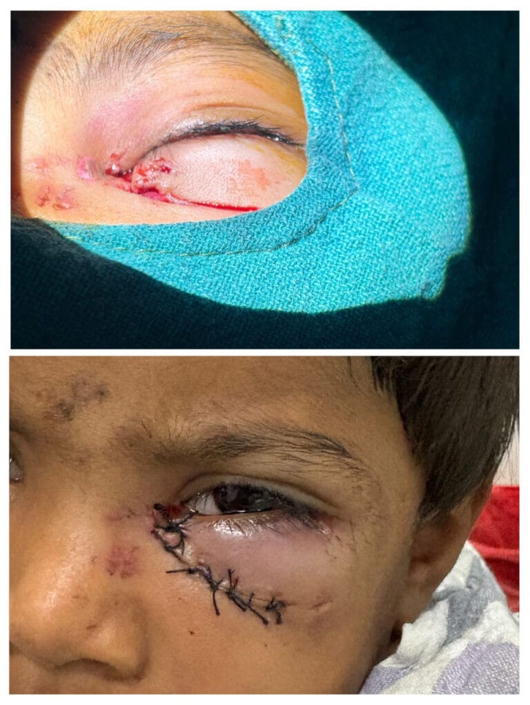 Two innocent children injured in a stray dog ​​attack in Batori village of Bilha area were successfully treated at SIMS.