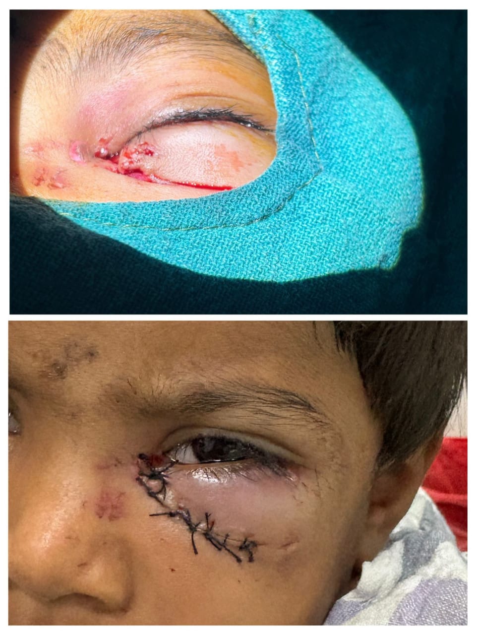 Two innocent children injured in a stray dog ​​attack in Batori village of Bilha area were successfully treated at SIMS.