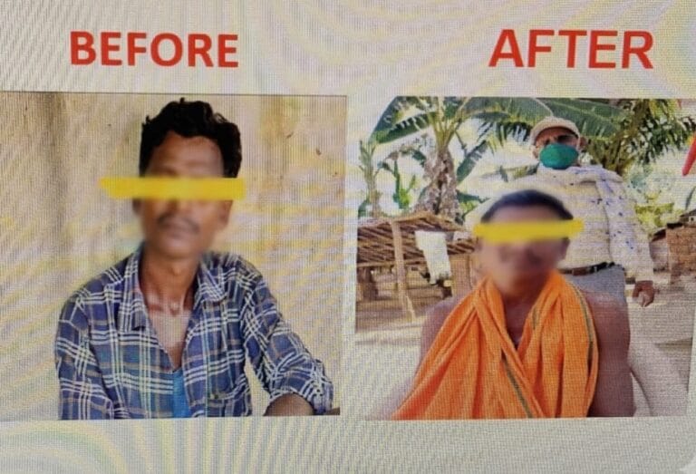  People living normal lives after timely treatment of leprosy