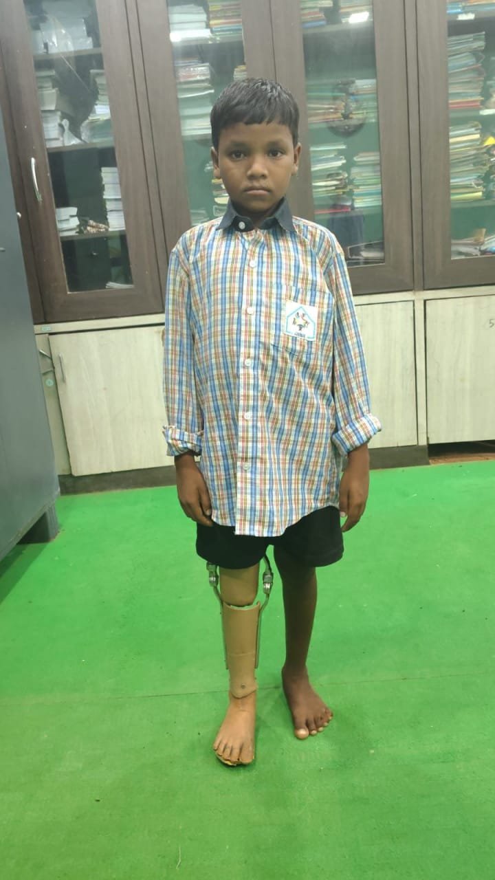 10-year-old Kamlesh gets prosthetic leg, now he will move towards his destination