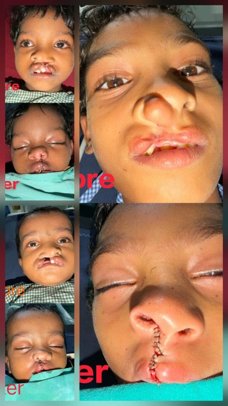 Chirayu Scheme Brings Relief from Congenital Condition; Smiles Return to Three Children